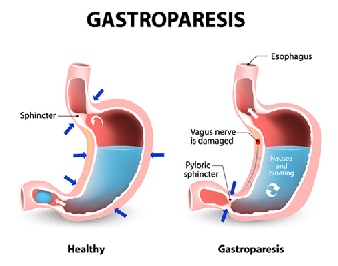 feat-gastroparesis